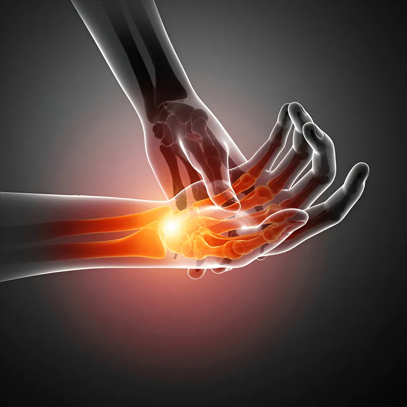 Carpal-Tunnel Syndrome-cat-img
