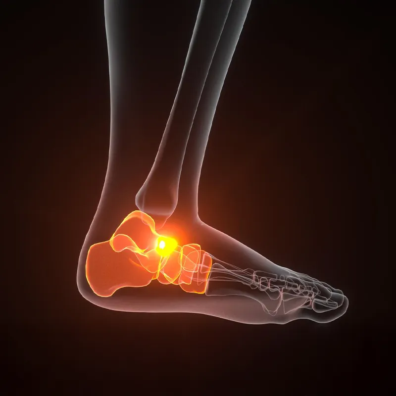 calcaneal-spur-cat-img